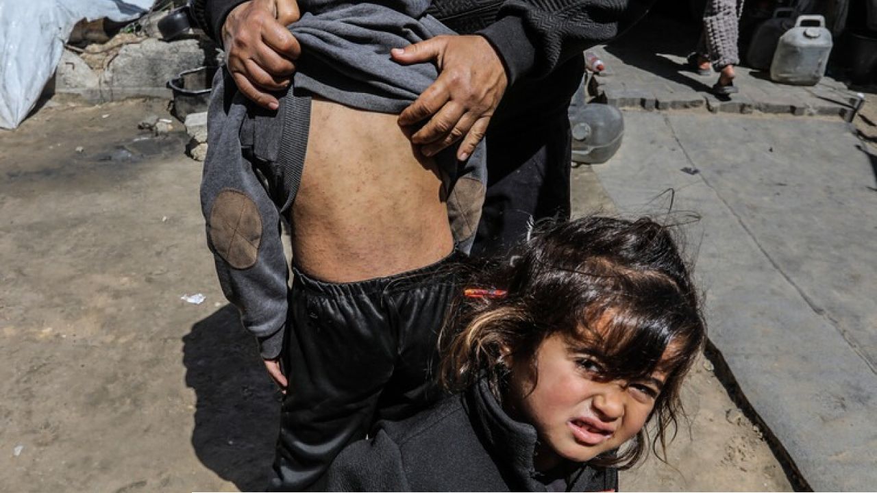 গাজায় চর্মরোগের মহামারি: ওষুধহীন শিবিরে বিড়ম্বনার জীবন